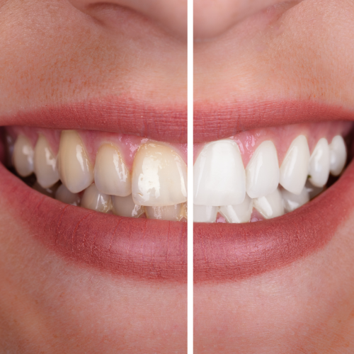 Clareamento dos Dentes